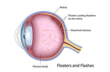 Flashes And Floaters Treatment