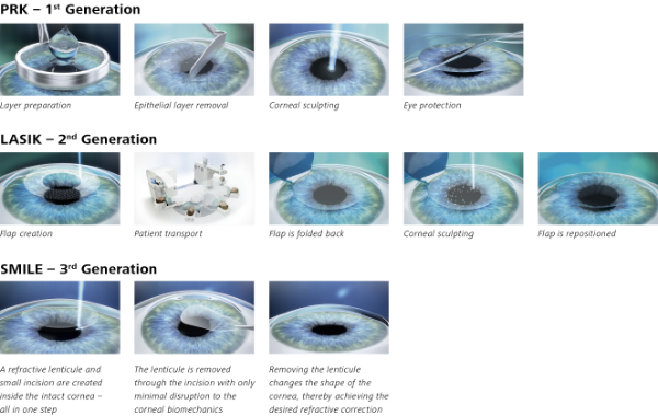 Laser Vision Correction Techniques