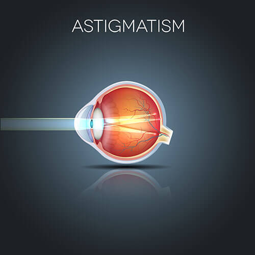 Chart Illustrating How Astigmatism Affects an Eye