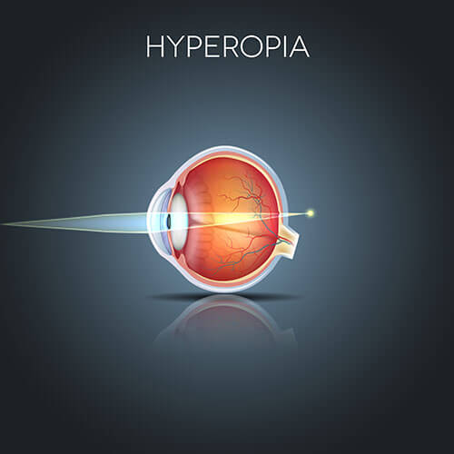 Chart Illustrating How Hyperopia Affects an Eye