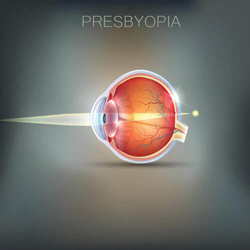 Chart Illustrating How Presbyopia Affects an Eye